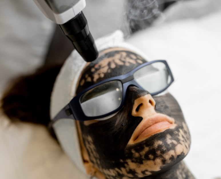 Carbon face mask treatment Walsall