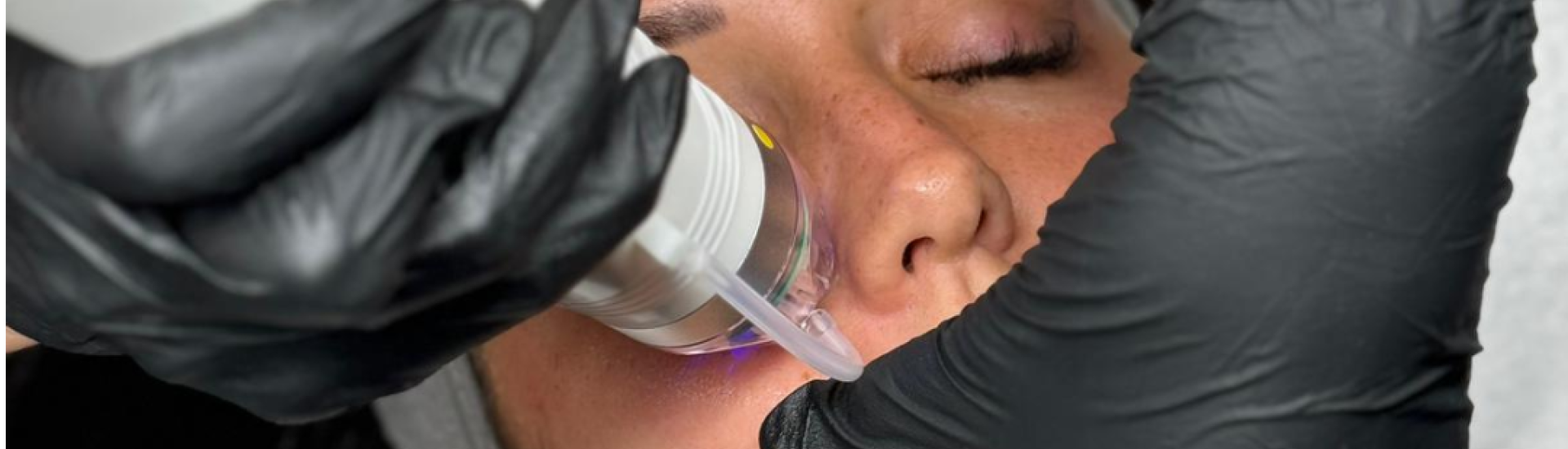 RF Microneedling Treatment Laser Tattoo Removal Walsall