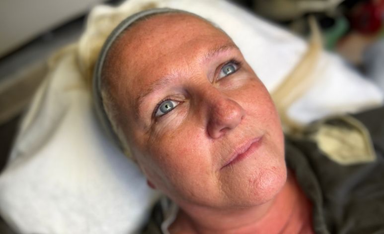 Before RF Microneedling Treatment