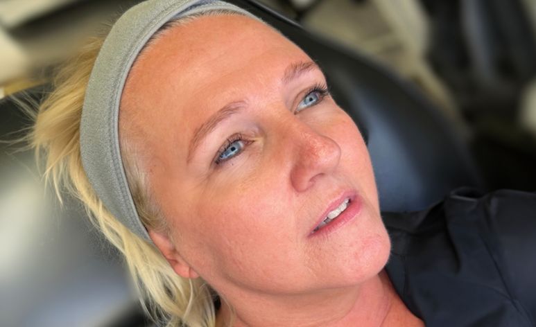 After RF Microneedling Treatment