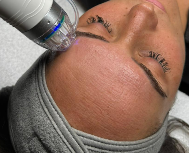 RF Microneedling Treatment Walsall