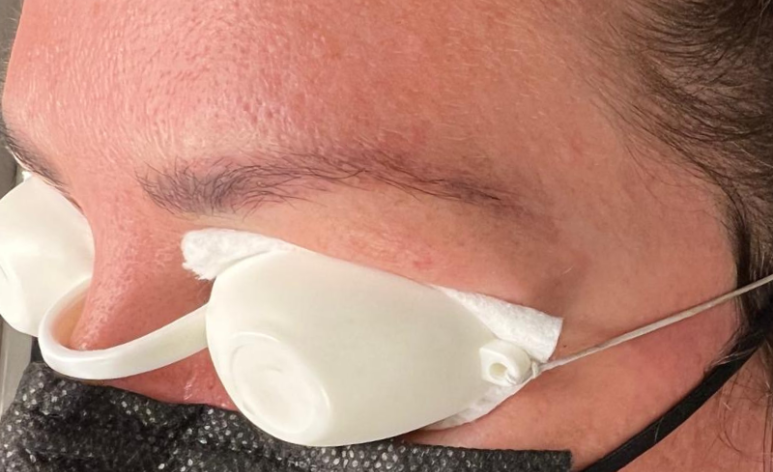 After Microblading Removal Treatment