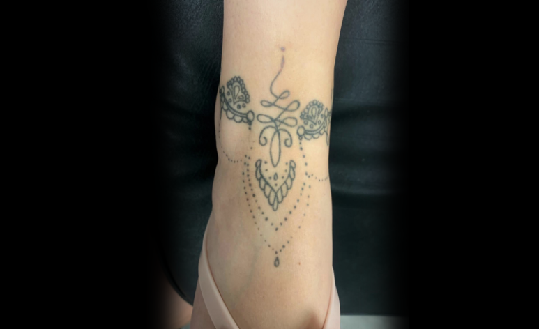 Before Laser Tattoo Removal Treatment Walsall