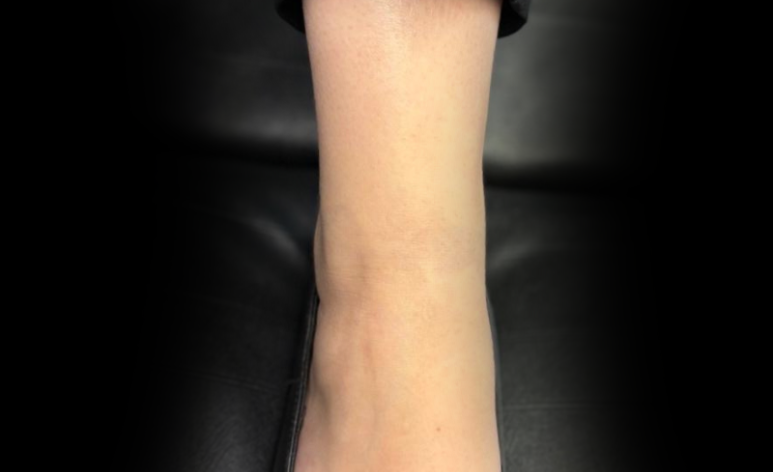 After Laser Tattoo Removal Treatment Walsall