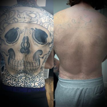 Laser Tattoo Removal Walsall Treatment Room