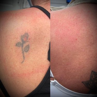 Laser Tattoo Removal Walsall Treatment Room