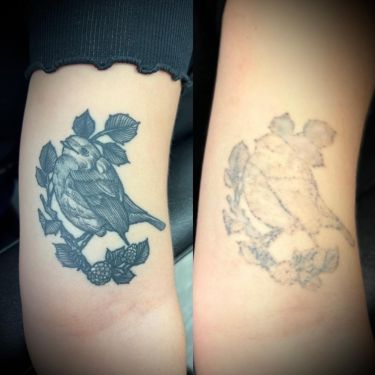 Laser Tattoo Removal Walsall Treatment Room