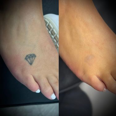 Laser Tattoo Removal Walsall Treatment Room