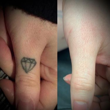Laser Tattoo Removal Walsall Treatment Room