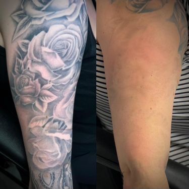 Laser Tattoo Removal Walsall Treatment Room