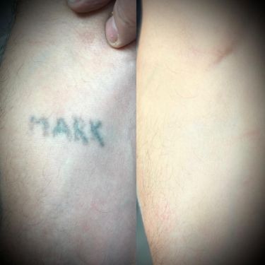 Laser Tattoo Removal Walsall Treatment Room