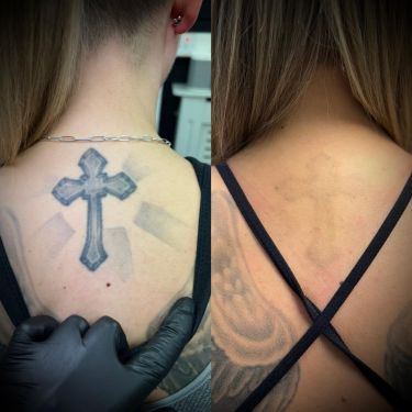 Laser Tattoo Removal Walsall Treatment Room