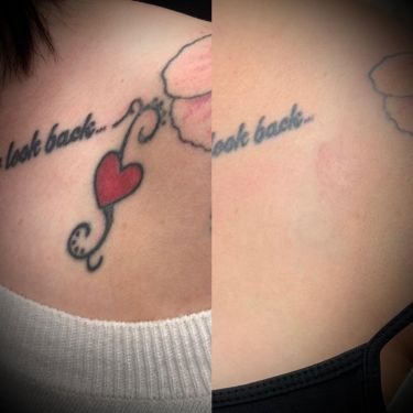Laser Tattoo Removal Walsall Treatment Room
