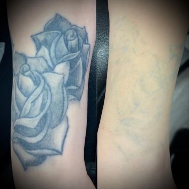Laser Tattoo Removal Walsall Treatment Room