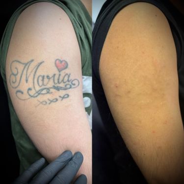 Laser Tattoo Removal Walsall Treatment Room