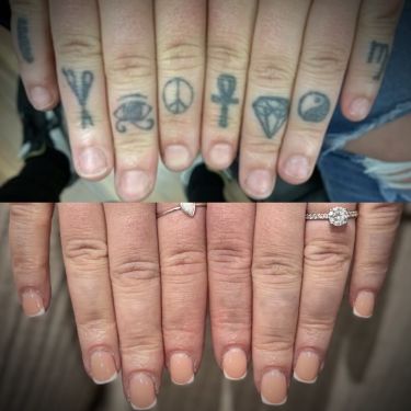 Laser Tattoo Removal Walsall Treatment Room
