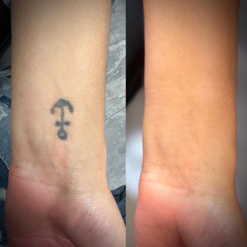 Laser Tattoo Removal Walsall Treatment Room