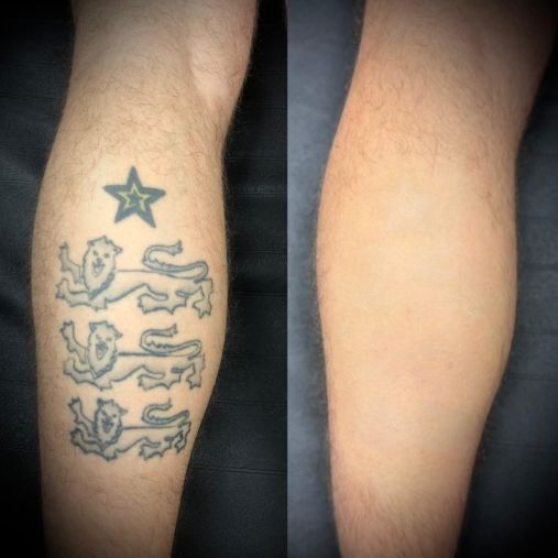 Laser Tattoo Removal Walsall Treatment Room