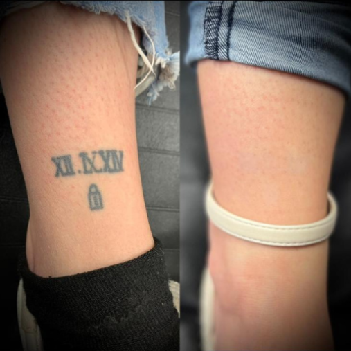 Laser Tattoo Removal Walsall Treatment Room