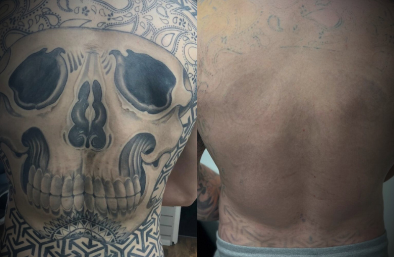 Jamie performing Laser Tattoo Removal Walsall