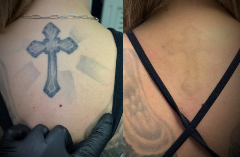 Jamie performing Laser Tattoo Removal Walsall