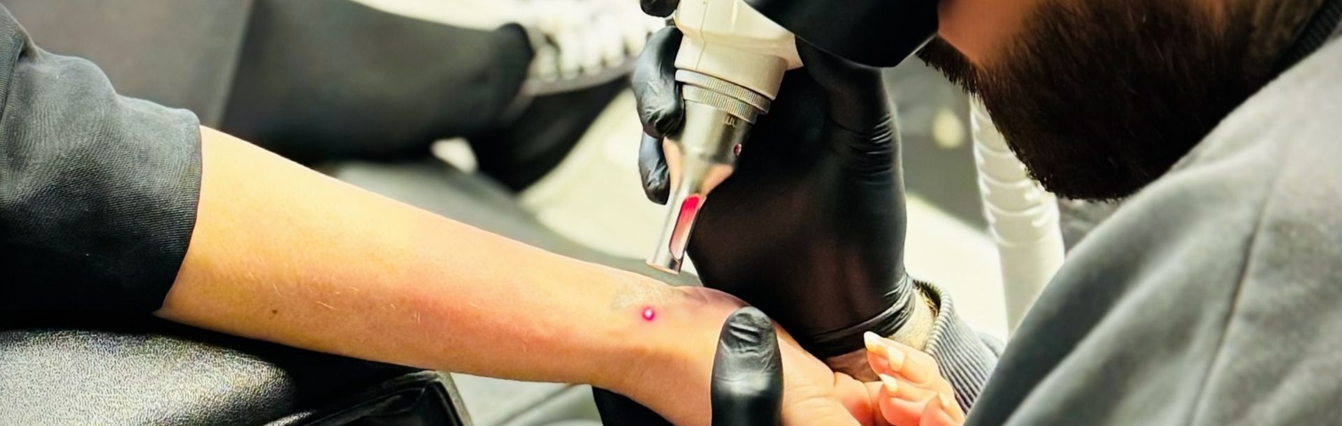Laser Tattoo Removal Walsall Treatment By Jamie