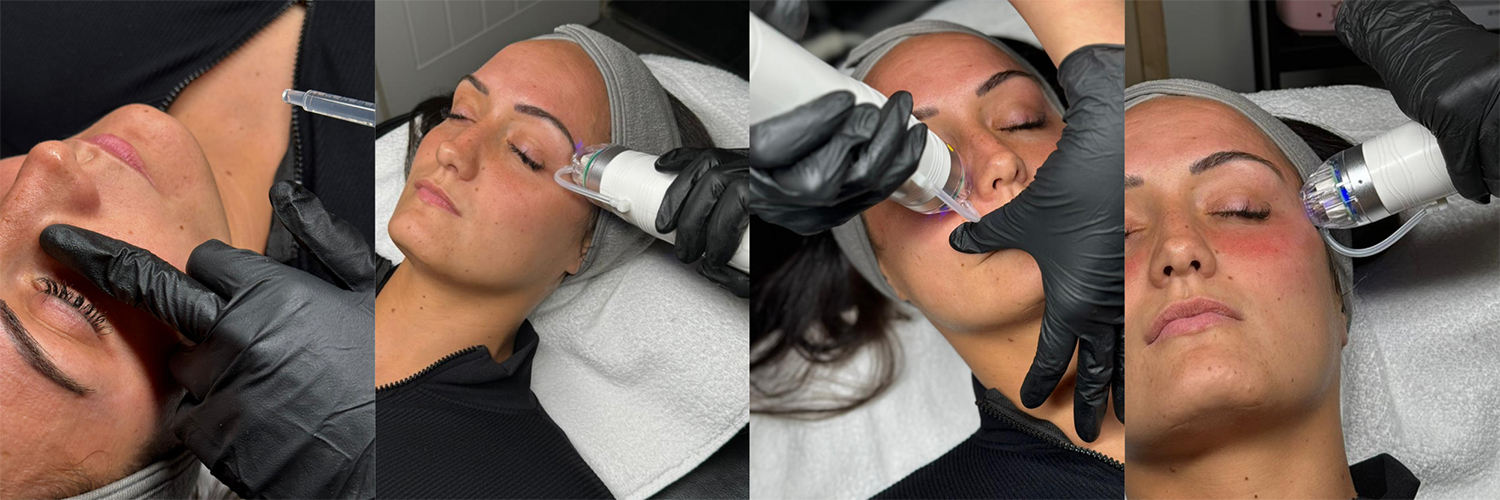 RF Microneedling Walsall Laser Tattoo Removal